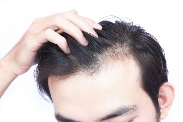 10 Cara untuk Menghentikan Rambut Rontok pada Pria